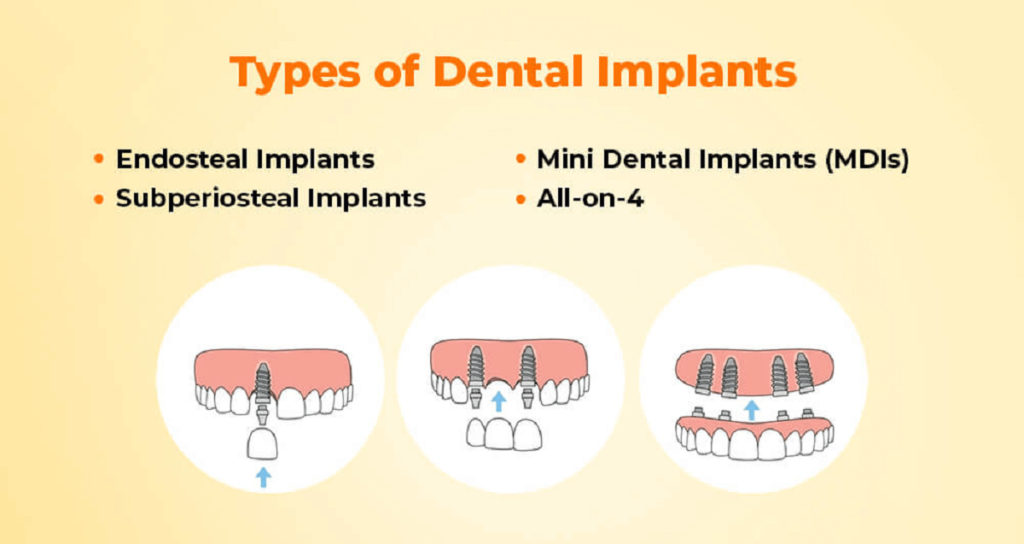 Dental Implant Types