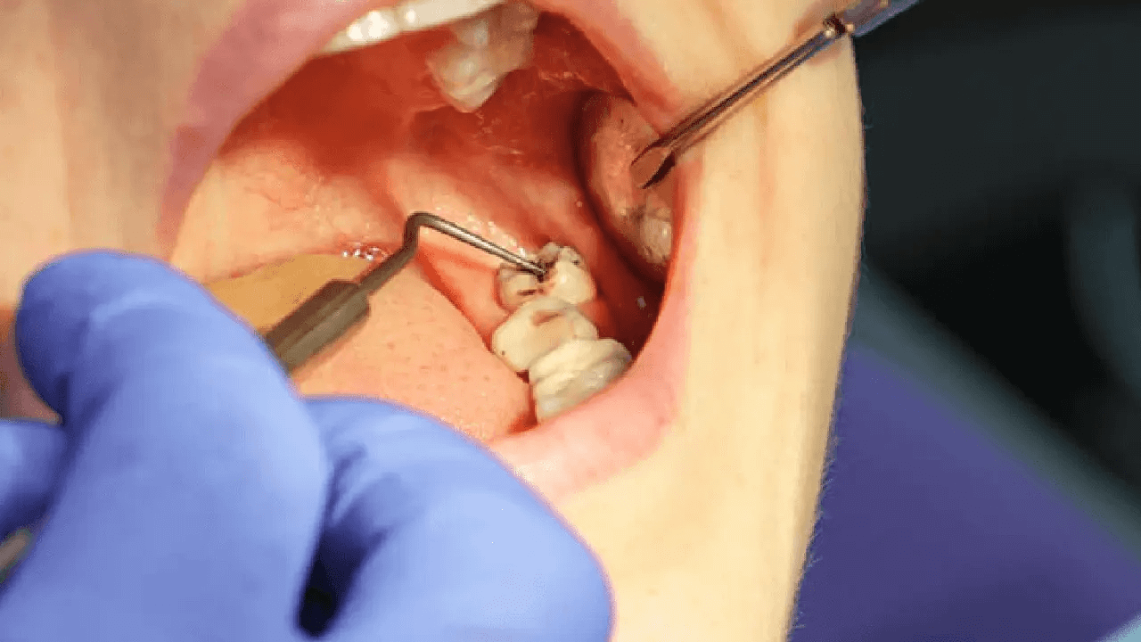 Dental Wisdom Tooth Removal