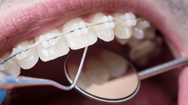 Dental adhesive for braces