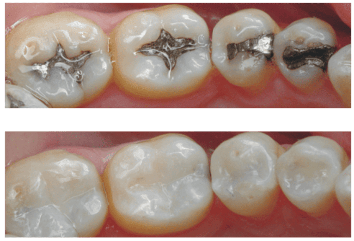 Dental amalgam vs composite fillings