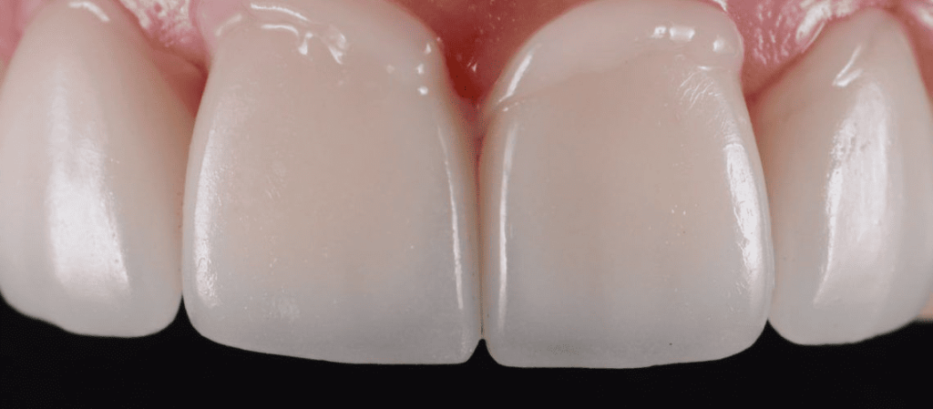 Dental bonding material on teeth