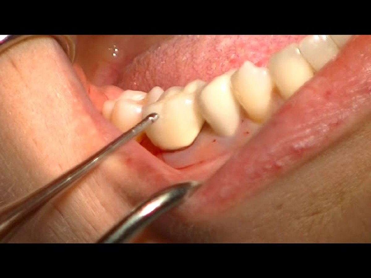 Dental crown removal