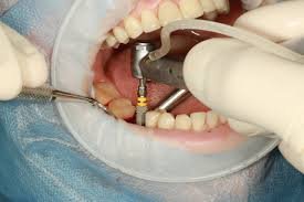 Dental implant procedure