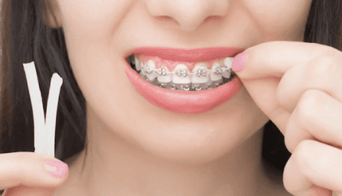 Dental wax for braces