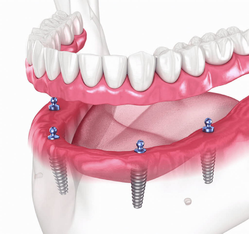 Denture Stabilization