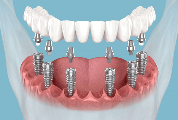 Denture Stabilization
