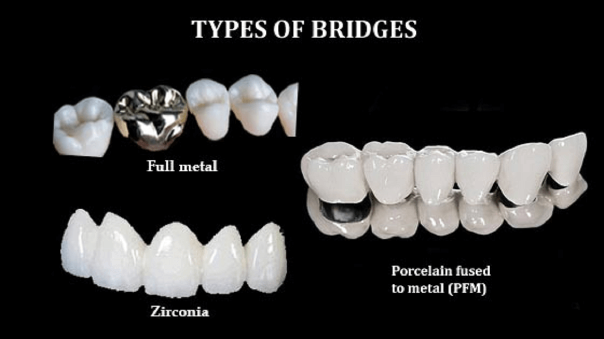 Different dental bridge materials
