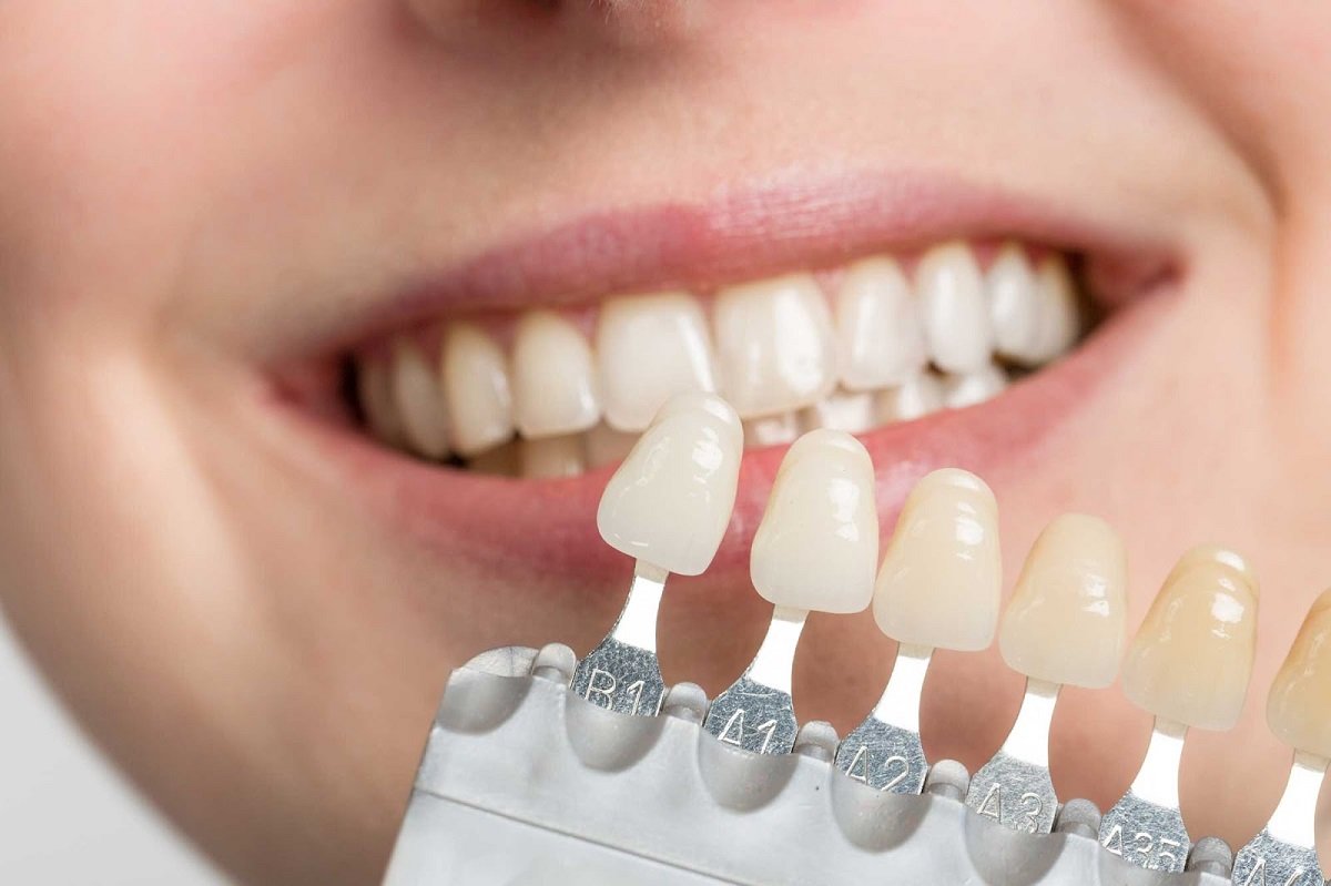 Different types of dental veneers