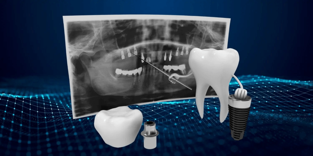 Digital Dental Implants