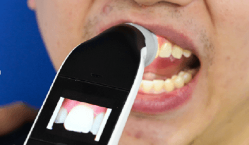 Digital Shade Matching Systems