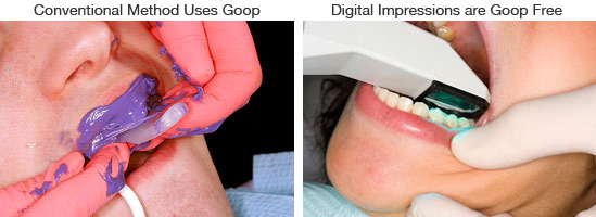 Digital vs Traditional Dental Impressions