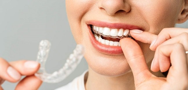 Essix Retainers