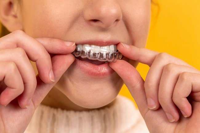 Essix Retainers