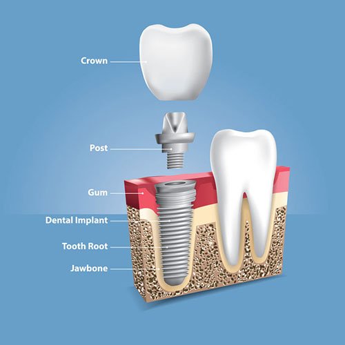 Fabrication of the Crown and Crown Positioning