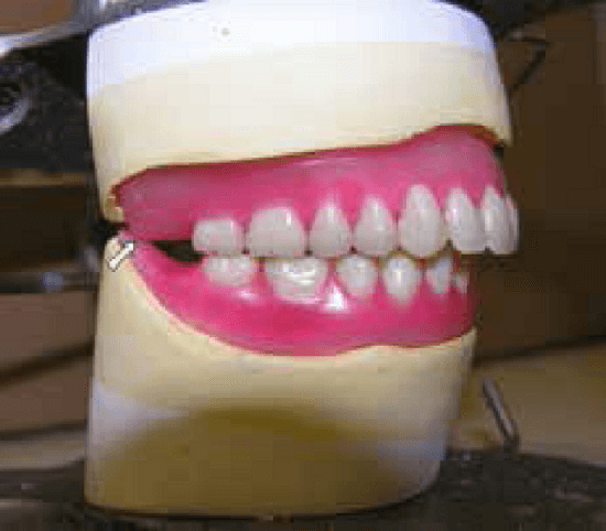Failed Dentures