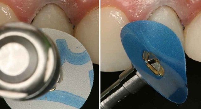 Finishing and Polishing dental resin