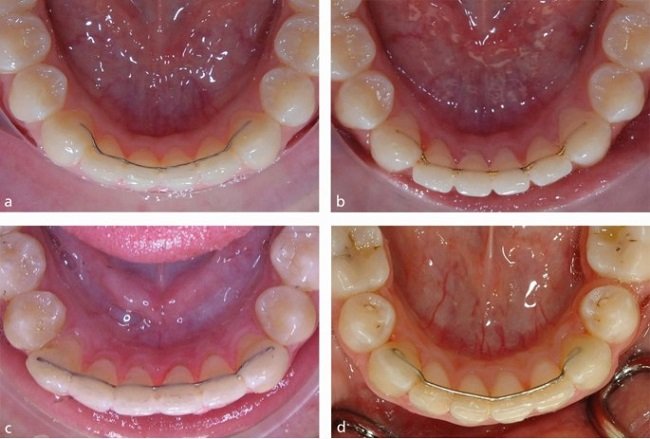 Fixed (Bonded) Retainers