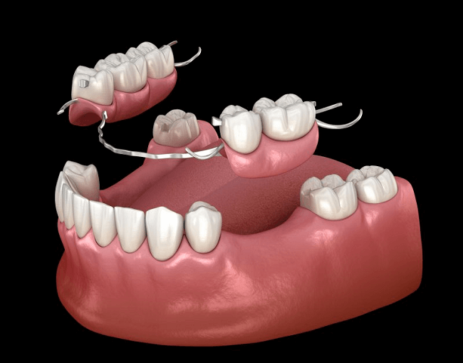 Fixed Partial Dentures