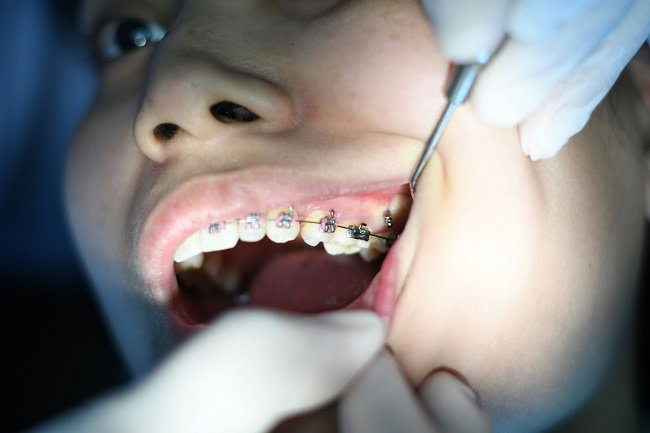 Fixing Braces