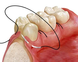 Flap surgery for dental periodontal treatment