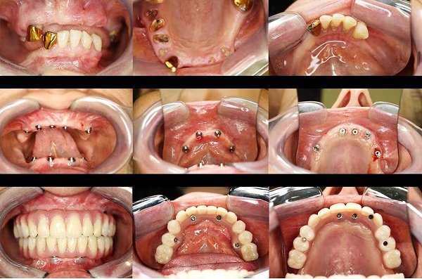 Full Arch Dental Implant Procedure