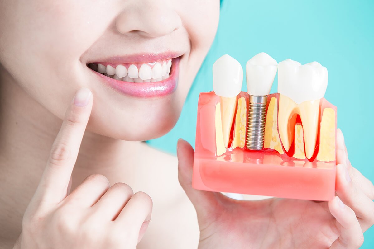 Full Arch Dental Implants: Procedure, Recovery & Cost Guide
