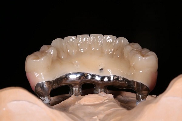 Full-Mouth Acrylic (PMMA) Restoration