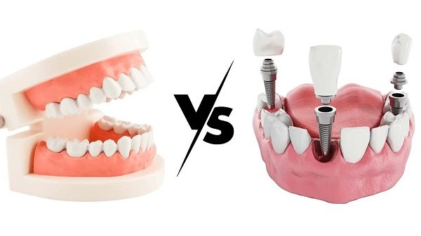 Full Mouth Dental Implants vs Denture