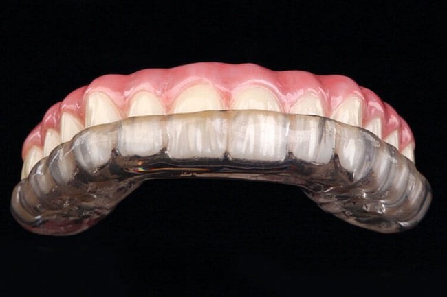 Full-arch splints
