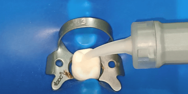 Glass Ionomer Cement (GIC)