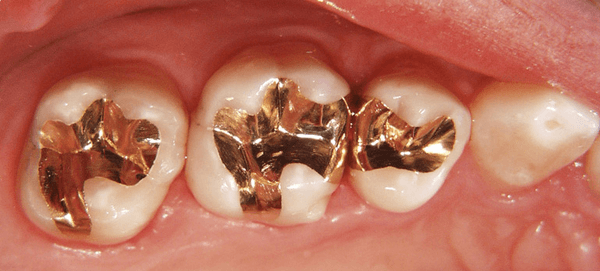 Gold dental tooth filling