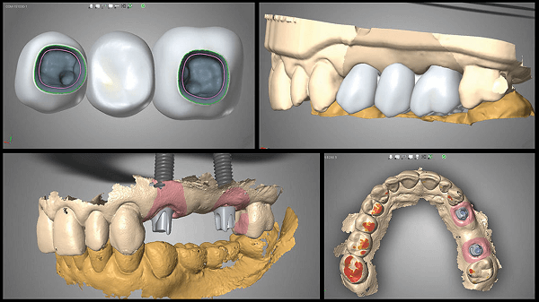 How Digital Dental Implants Work