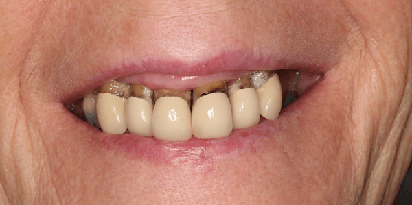 How Immediate Dentures Work?