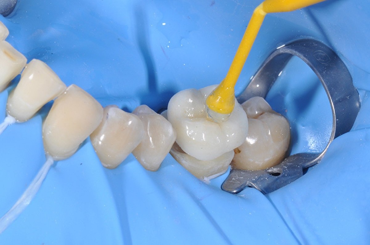 How to bond zirconia