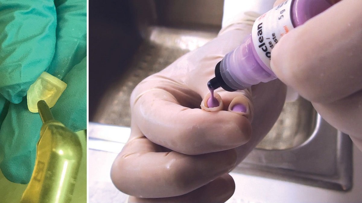 How to cement zirconia crown