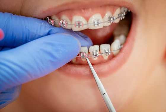 How to use dental wax