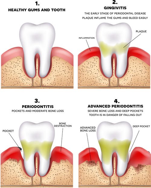 Illustration of 4 stages of periodontal disease
