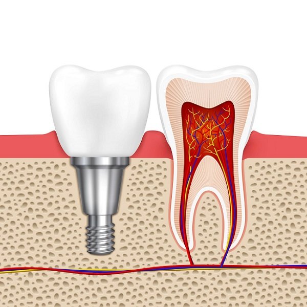 Illustration of a dental implant