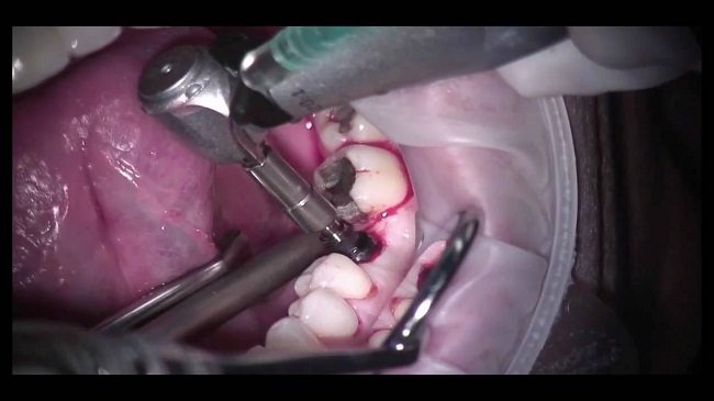 Implant Placement Surgery