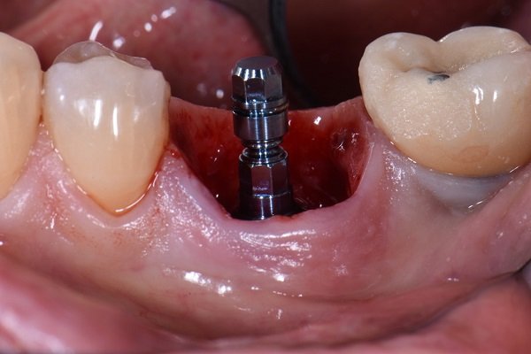 Implant placement
