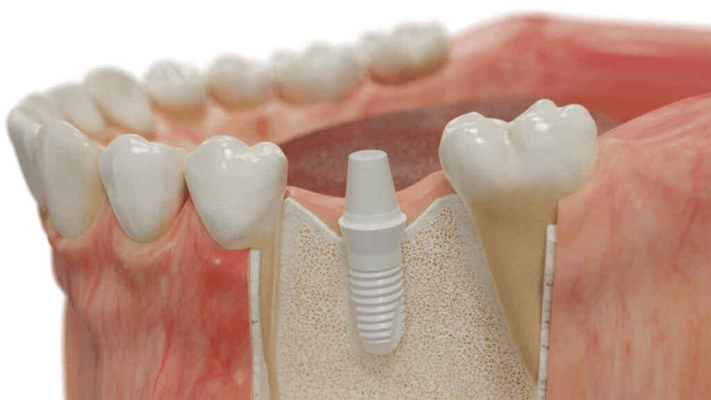 Implant with dental zirconia materials