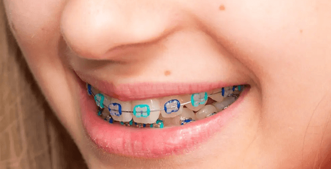 Kid smiling with braces