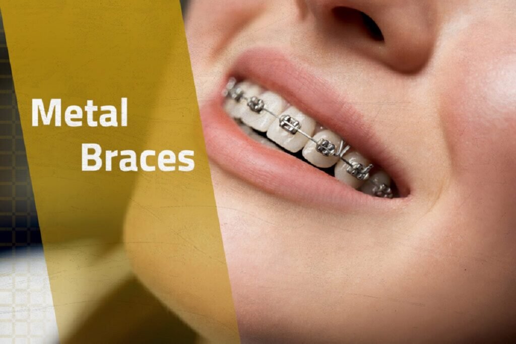 Metal Braces