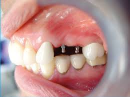 Mini Dental Implants