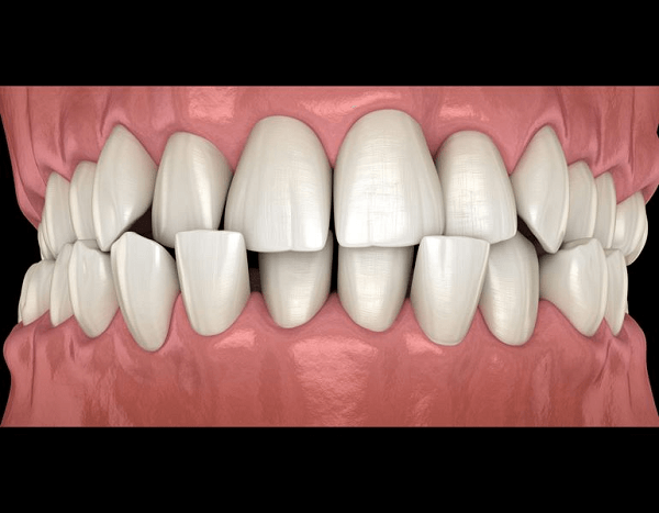 Misaligned Teeth