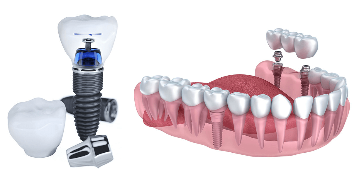 New Dental Implant Technology