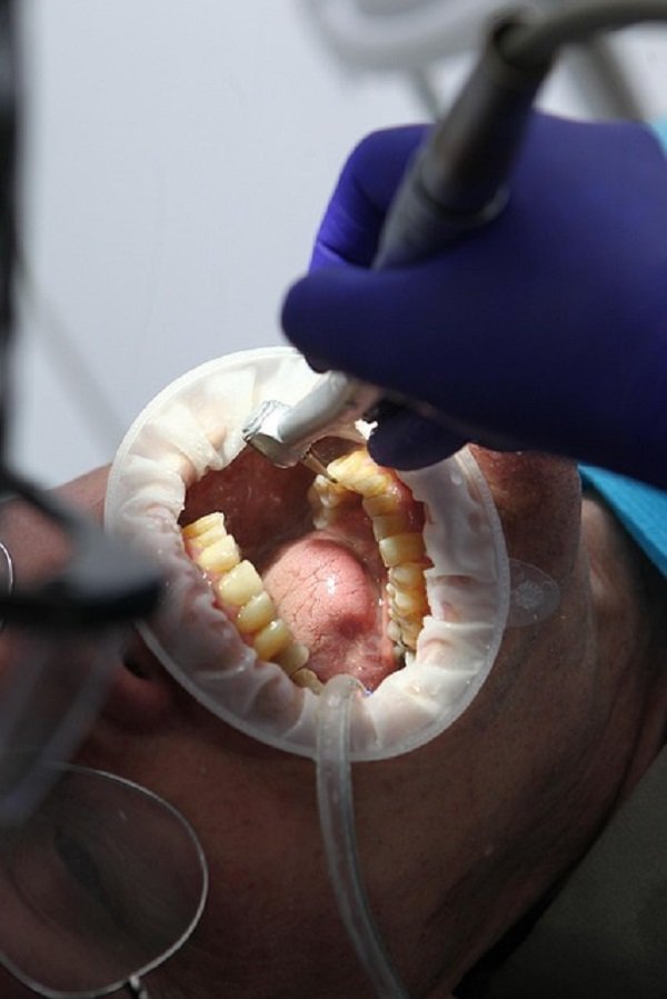 Ongoing process of dental scaling and root planing