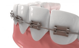 Orthodontic wires