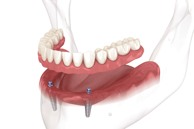Overdentures