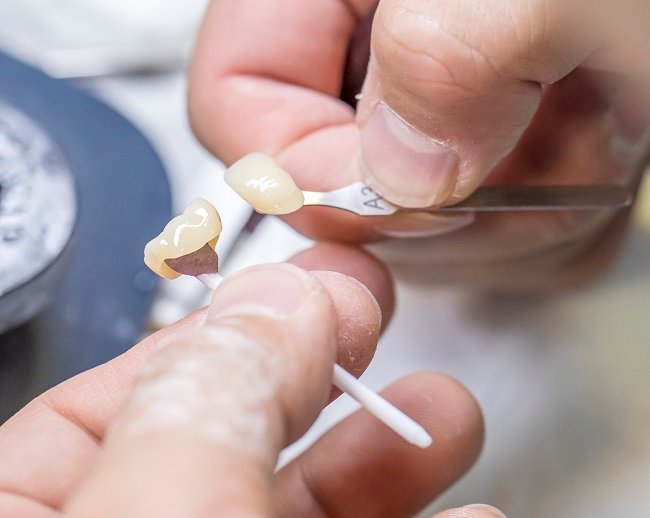 PMMA Temporary Crown Cementation